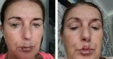Infecție la nivelul buzelor