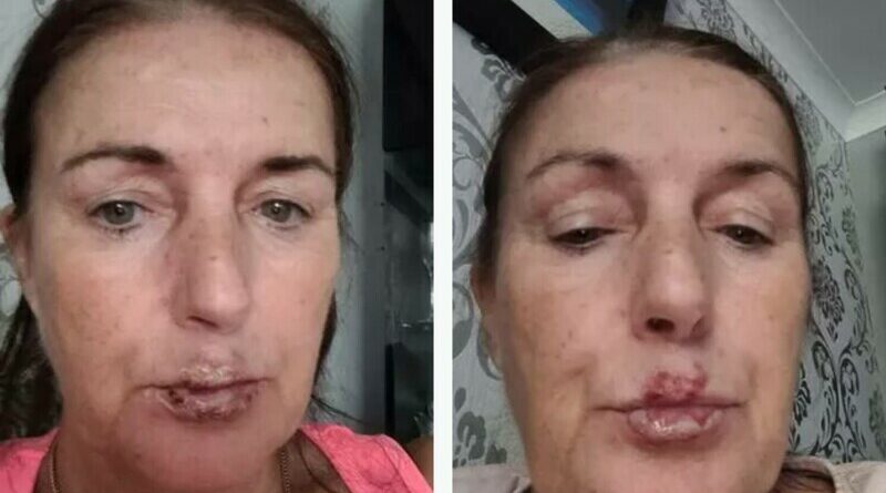 Infecție la nivelul buzelor